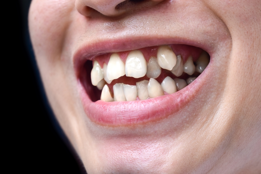 The Crooked Teeth & Sleep Apnea Connection