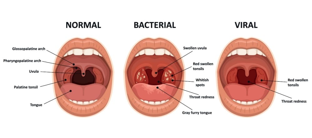 swollen tonsils honolulu hi