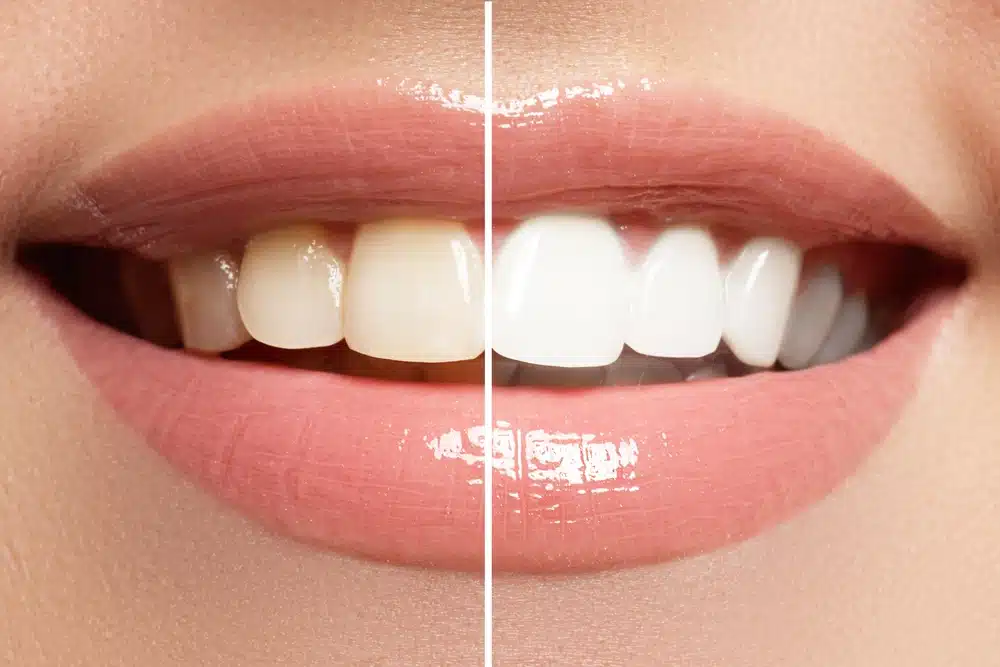How Take-Home Whitening Kits Work