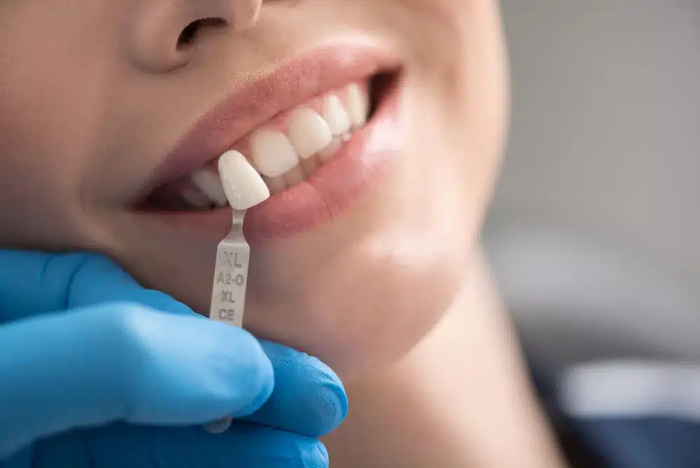How LED-Activated Systems Are Revolutionizing Whitening Results
